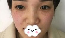 激光祛斑视频全过程,安全高效，美丽蜕变